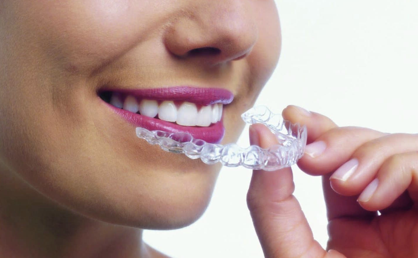 What Is Invisalign and Is It the Right Option for You?